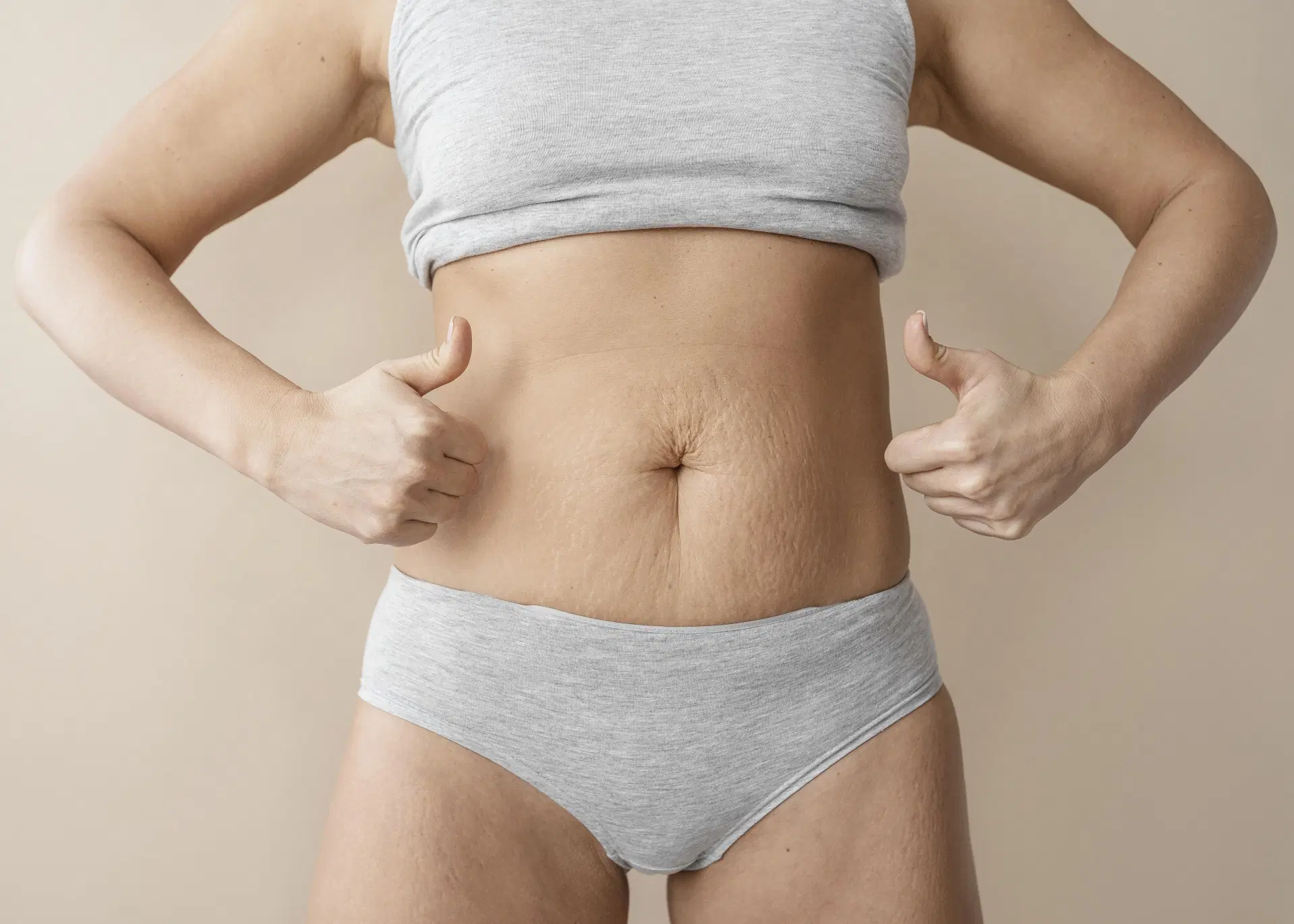 Estrias: Entendendo seu Surgimento e Dicas para Prevenção