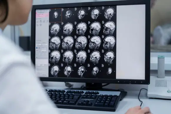 Malformação de Chiari: o que é e quando procurar um neurocirurgião