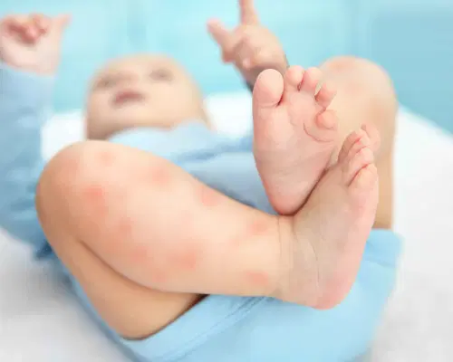 Entenda mais sobre a alergia alimentar em crianças!