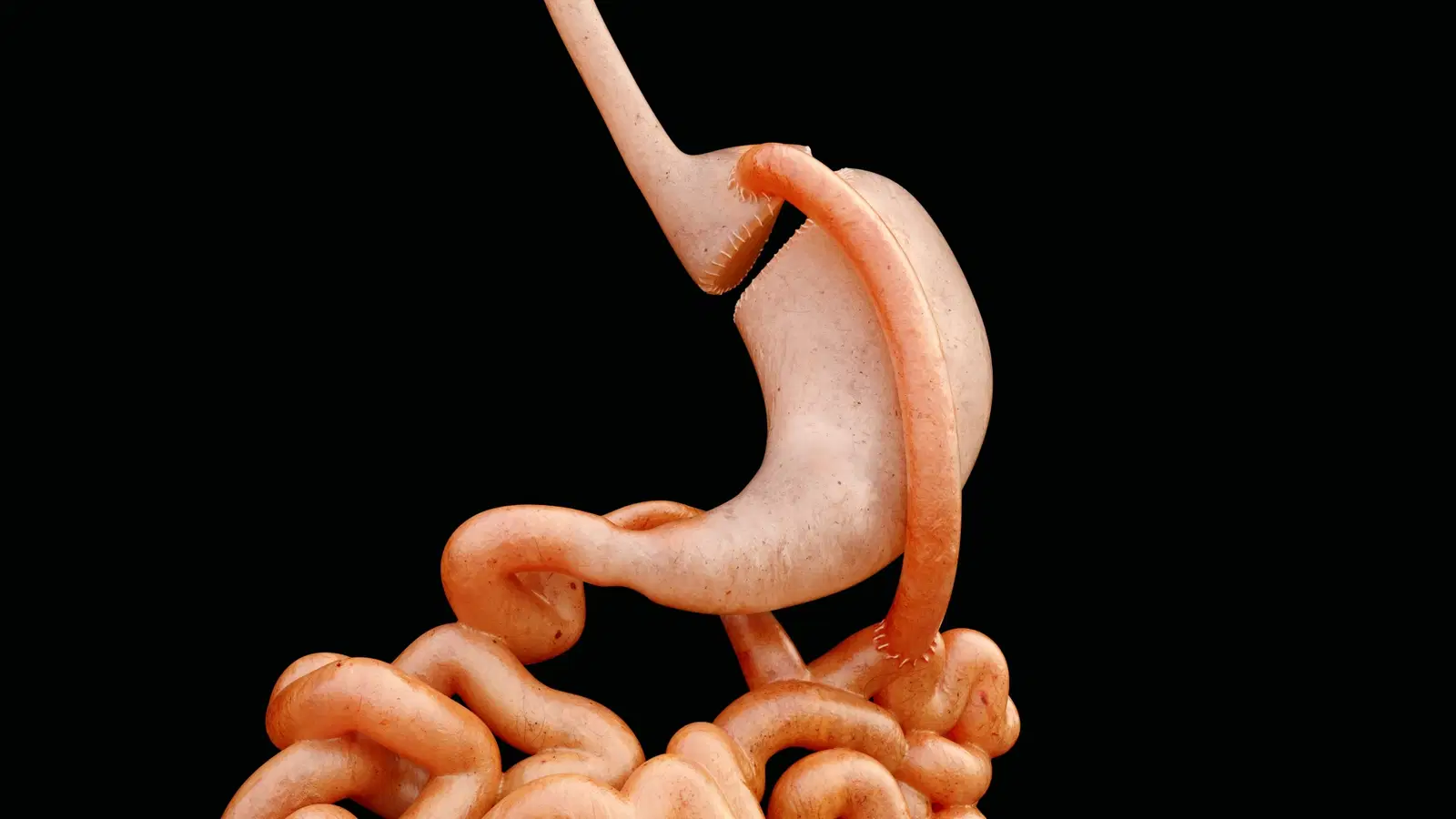 Bypass ou sleeve? Entenda a diferença entre essas duas técnicas de cirurgia bariátrica