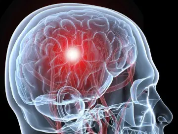 O que é isquemia cerebral?