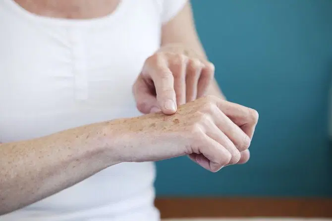 Laserterapia para manchas sênis