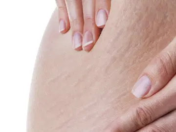 O que são estrias e como tratá-las?