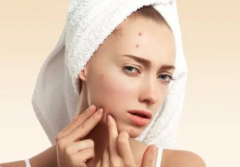 Acne na vida adulta: por que as espinhas continuam aparecendo?