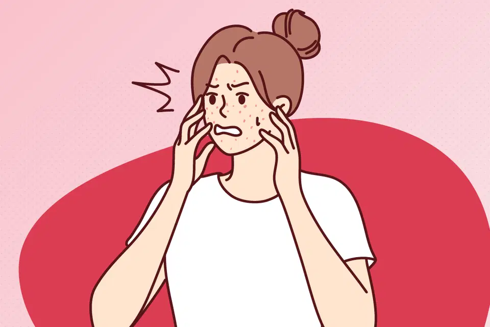 DIU hormonal piora a acne?