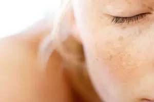 A relação entre melasma e os raios solares