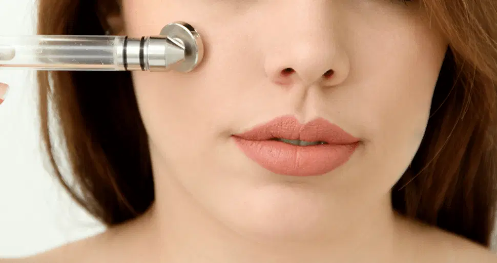 Peeling de CO2