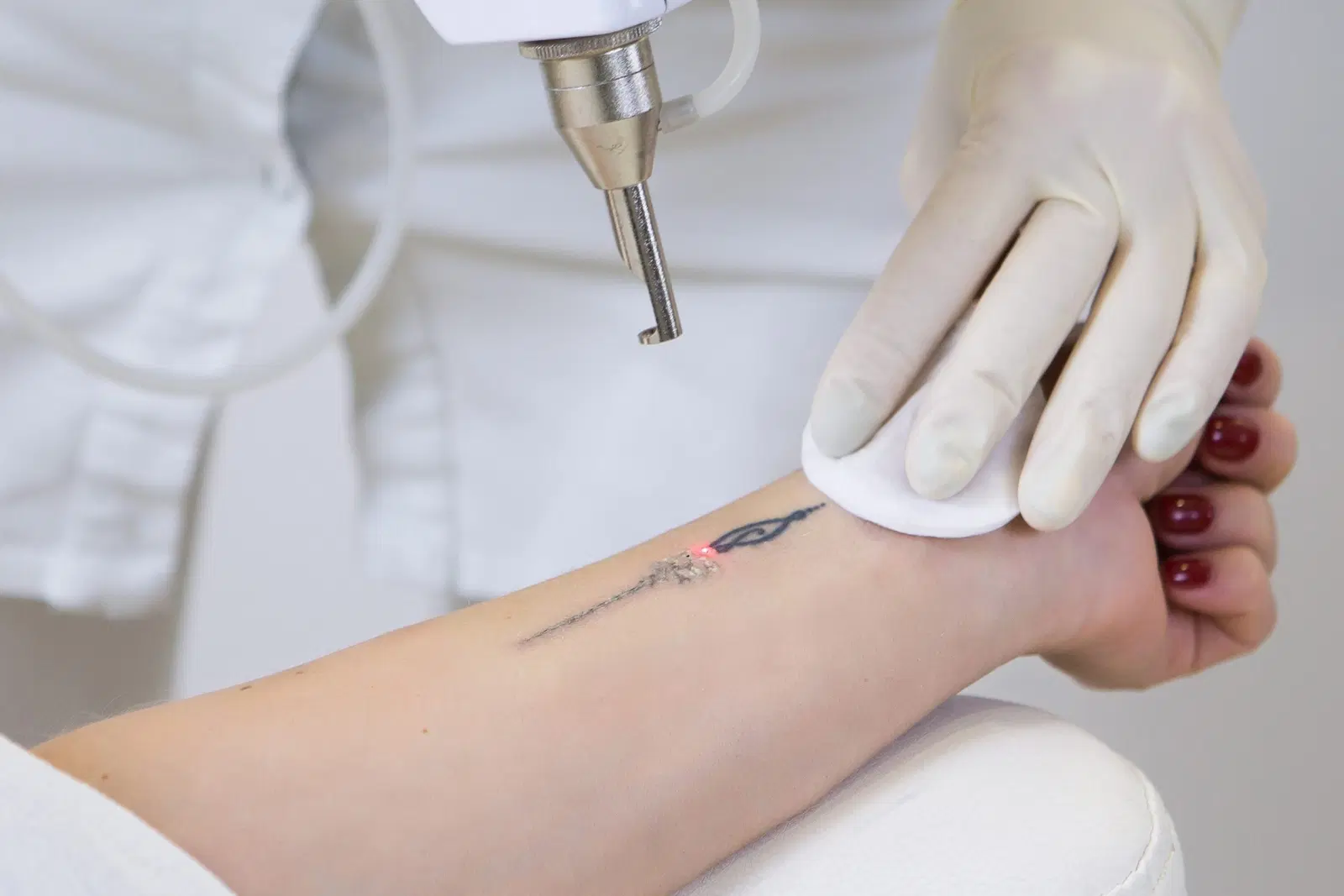 Remoção de Tatuagens e Micropigmentação