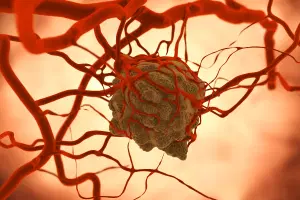 Quais são os tipos de tumores cerebrais?