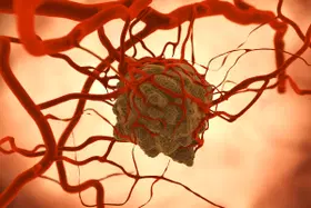 Quais são os tipos de tumores cerebrais?