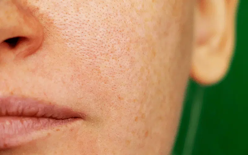 Quais as áreas do corpo mais afetadas pelo melasma?