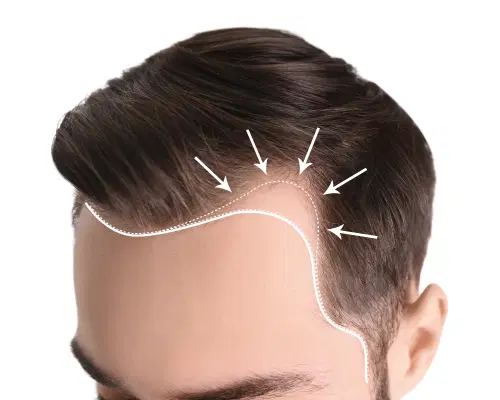 Conheça as principais causas da alopecia androgenética, a calvície