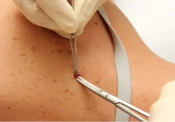 Dermatologia Cirúrgica