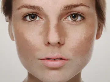 Tudo sobre melasma