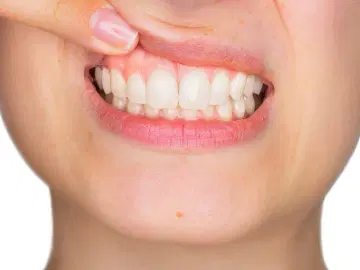 A relação entre aneurisma neural e infecções bucais