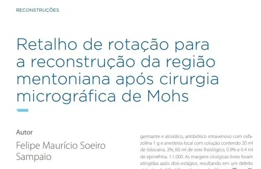 Mais um artigo publicado na revista da SBCD - Sociedade Brasileira de Cirurgia Dermatológica!