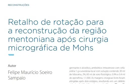 Mais um artigo publicado na revista da SBCD - Sociedade Brasileira de Cirurgia Dermatológica!