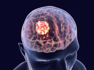 Quais são as características do tumor cerebral?