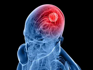 Os sintomas dos tumores cerebrais