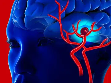 O que são aneurismas cerebrais?