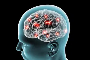 O que é angioma cavernoso e quais são os seus sintomas?