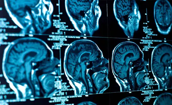 NEUROCIRURGIA ONCOLÓGICA