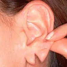 Lobuloplastia, a cirurgia para correção da orelha rasgada