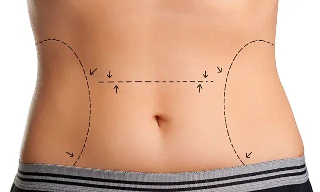ABDOMINOPLASTIA — Rogério Morale