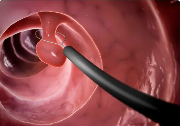Endoscopia terapêutica: muito além do diagnóstico