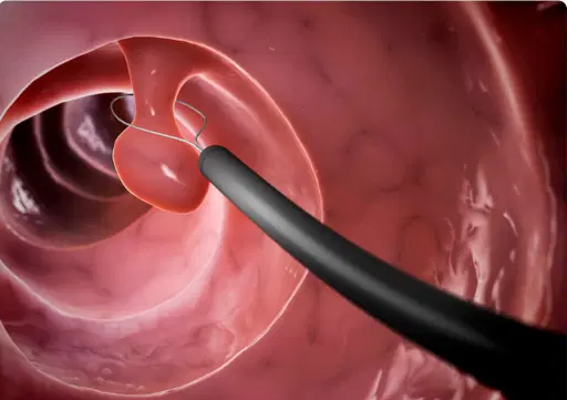 Endoscopia terapêutica: muito além do diagnóstico