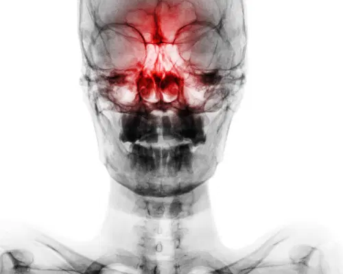 Cirurgia de sinusite: quando ela é indicada?