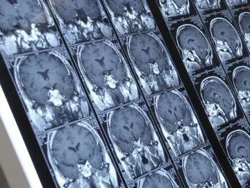 Epilepsia pode ser tratada com cirurgia