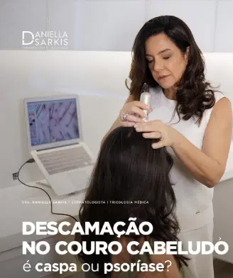 Coceira e descamação no couro cabeludo persistem? Entenda quando pode ser mais do que caspa