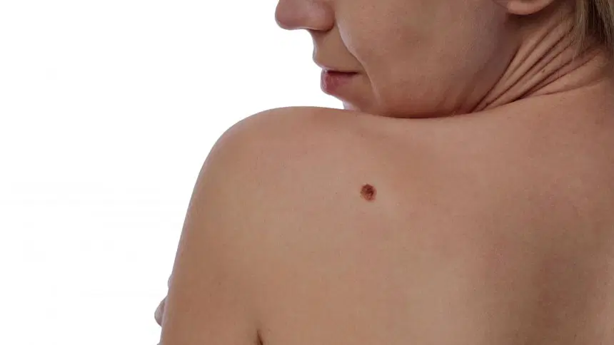 Tudo sobre melanoma