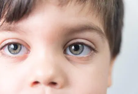 Retinoblastoma: quando o brilho nos olhos é um sinal de alerta