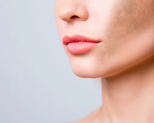 Manchas escuras na pele? Saiba como prevenir e tratar o melasma!