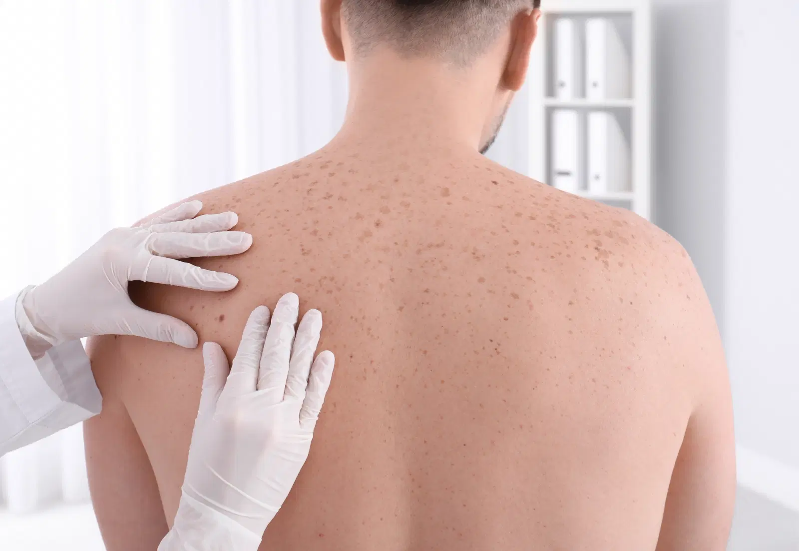 Câncer de pele pode ser agressivo e se espalhar pelo corpo!