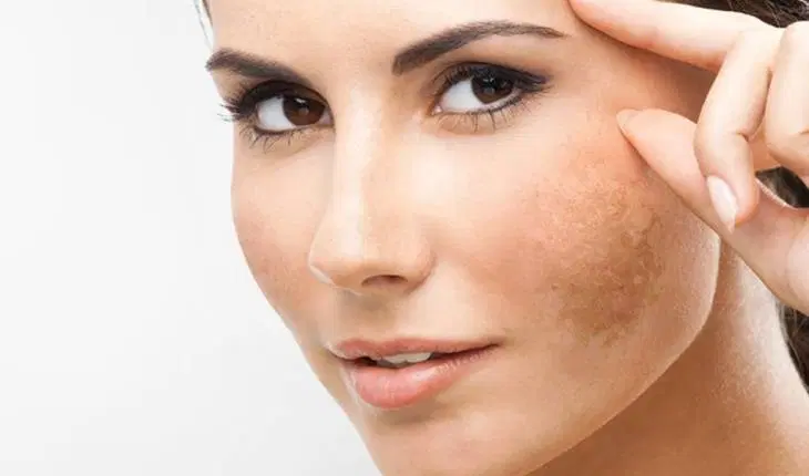 Melasma: Dra. Gabriela Bernhard esclarece as principais dúvidas sobre o distúrbio