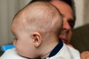 O que é craniossinostose?