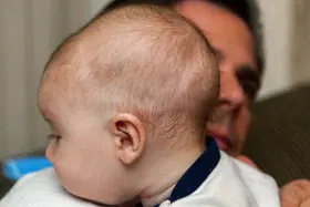 O que é craniossinostose?