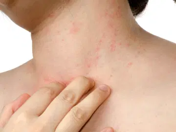 Você sabe o que é dermatite atópica?