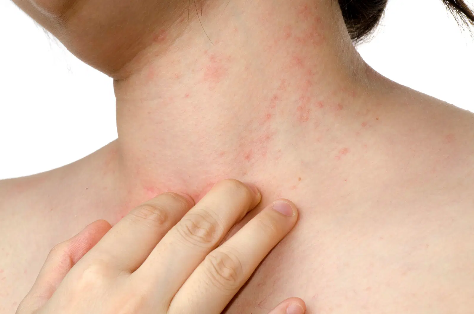 Cuidados na dermatite atópica