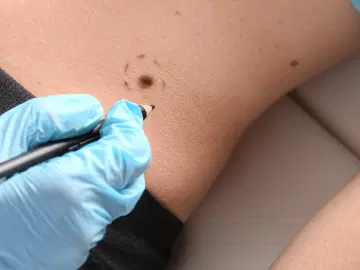 Os tratamentos para câncer de pele