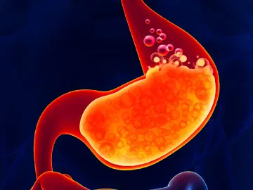 O que é a doença de refluxo gastroesofágico (DRGE)?