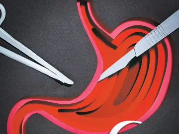 Tudo que você precisa saber sobre cirurgia bariátrica