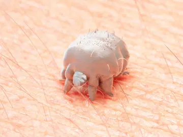Você já ouviu falar em escabiose ou sarna humana?