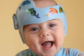 Cranioestenose: problemas com a formação do crânio do bebê