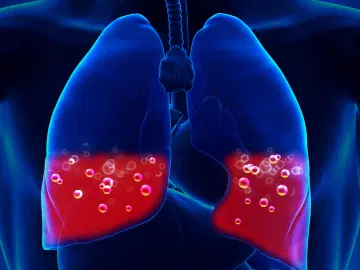 O que é embolia pulmonar?