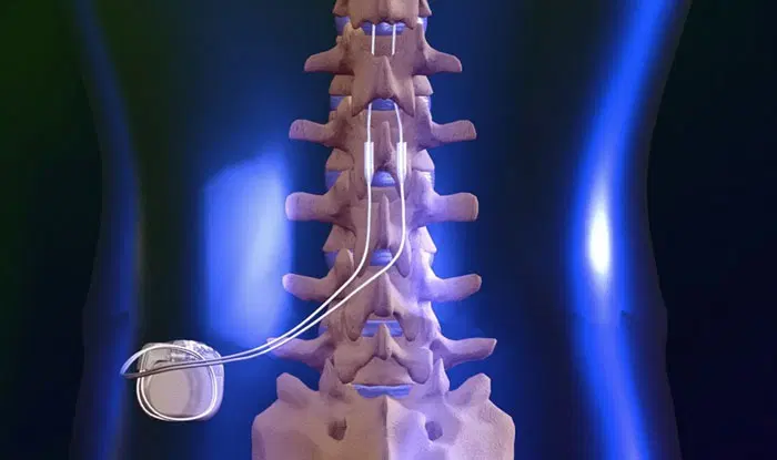 IMPLANTE DE ELETRODO MEDULAR