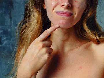 Tudo que você precisa saber sobre acne